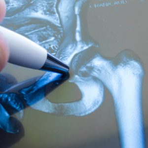 Pointing to Hip xray with pen