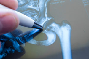 X-ray of hip joint. Doctor pointed on area of hip joint, where pathology is detected, such as fracture, destruction of joint, coxarthrosis, osteoarthritis. Diagnosis of joint diseases by radiology