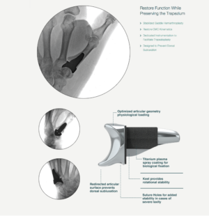 Wrist Implant