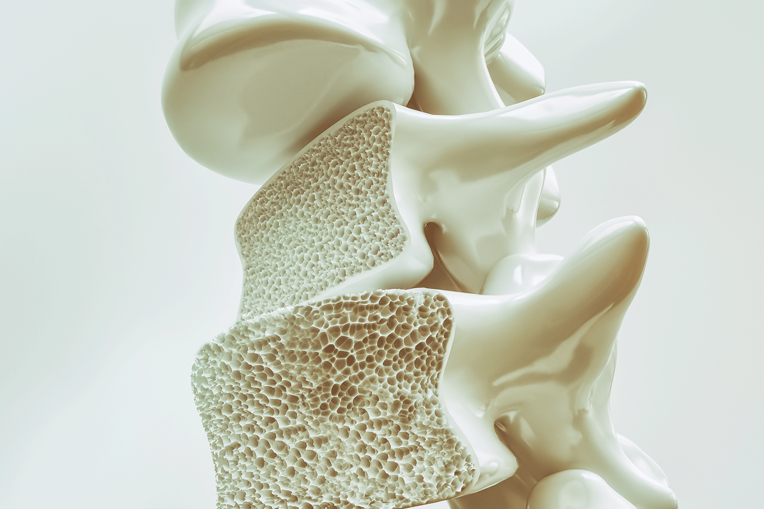 osteoporosis
